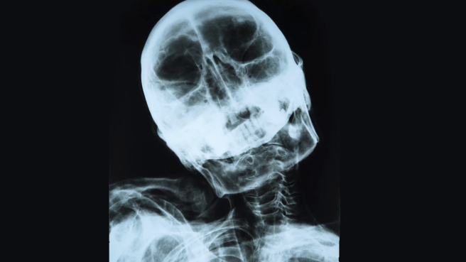 10_Nazca_mummy_X_ray